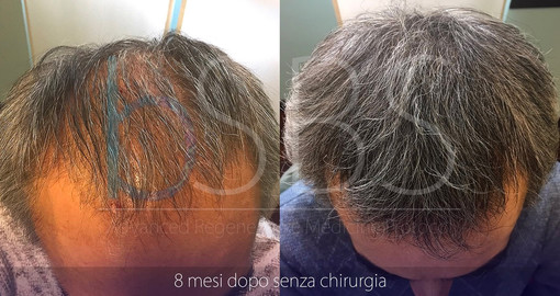 Alopecia, le potenzialità della Rigenerazione Cellulare