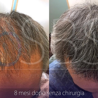 Alopecia, le potenzialità della Rigenerazione Cellulare