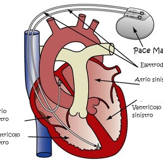 Salute: il pace-maker un piccolo, intelligente salvavita