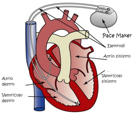Salute: il pace-maker un piccolo, intelligente salvavita