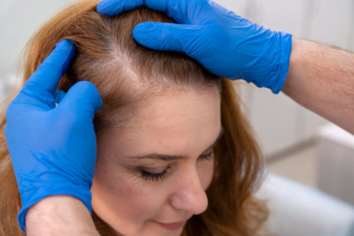 ContactSkin: il rinfoltimento non chirurgico dei capelli