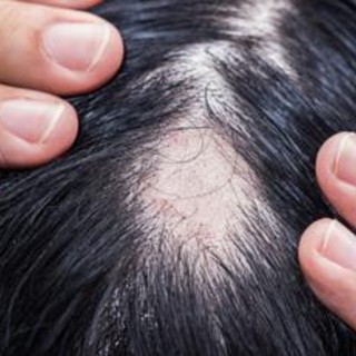 Alopecia areata, ok Aifa a rimborsabilità nuovo trattamento